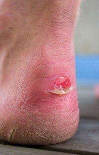 Causes of Blisters