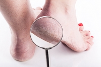 Medical Conditions And Cracked Heels