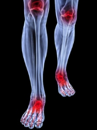 Rheumatoid Arthritis Affects the Toes