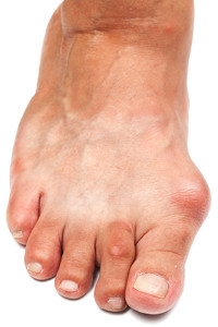 Are Bunions Genetic?