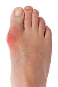 Two Types of Gout
